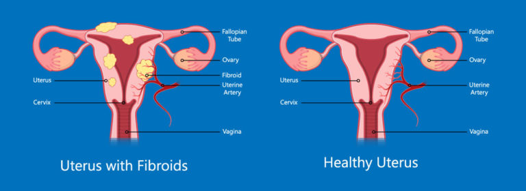 Fibroids Polyps And Adenomyosis Mph Ivf Center